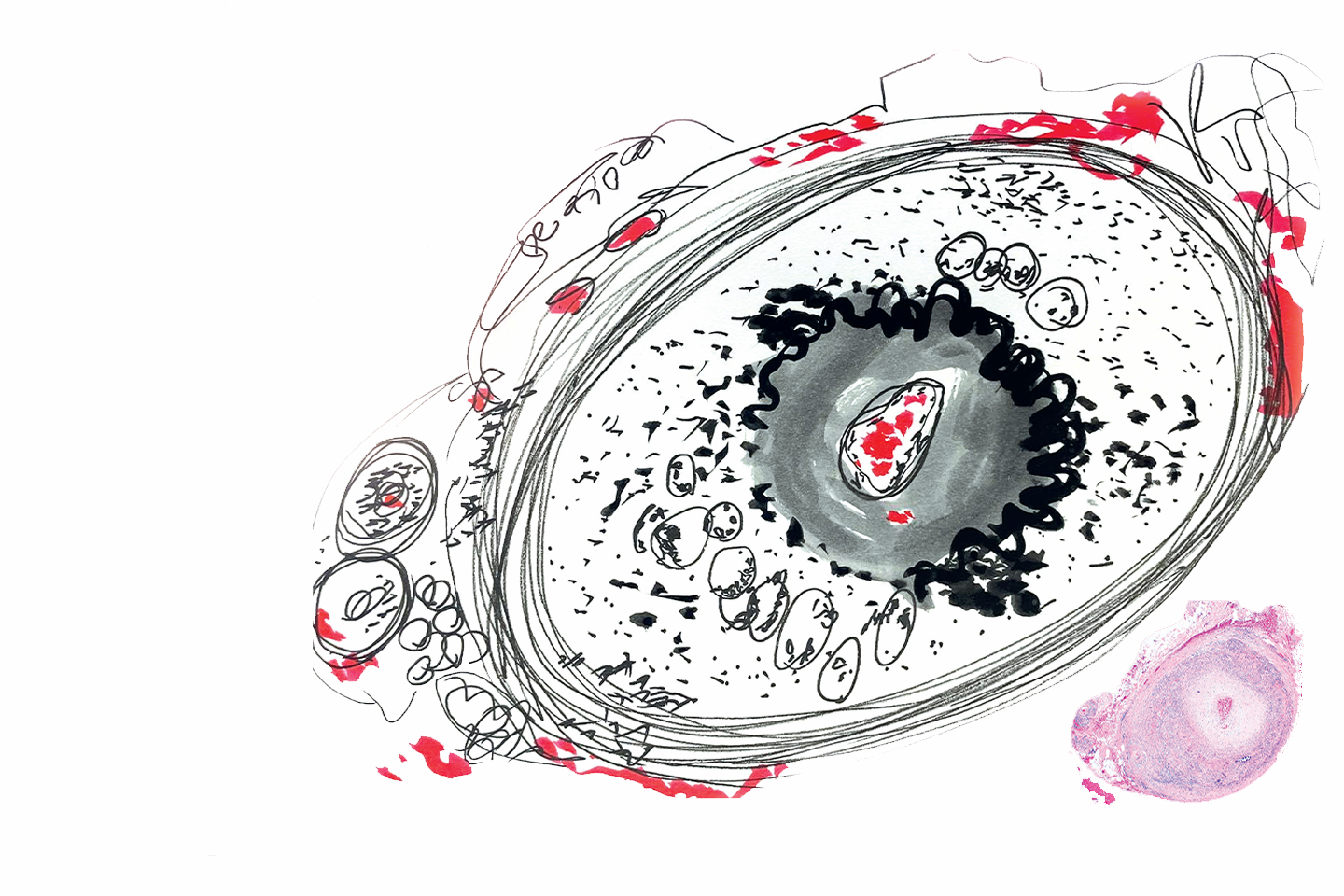 Two versions of a temporal artery with abundant chronic inflammation and other signs of temporal arteritis. The larger ink on
paper drawing is a graphic representation of the H&E-stained slide image (insert). Dr. Hilary Highfield, the artist (and Director of
Neuropathology at the Norton Neuroscience Institute), uses her artwork to highlight pertinent histologic findings. Her work will
be featured in an upcoming second edition of an eye pathology casebook by Drs. Daniel Albert (the Founding Director of the
McPherson ERI) and Hillary Stiefel. • IMAGES COURTESY OF HILARY HIGHFIELD, MD, PHD.