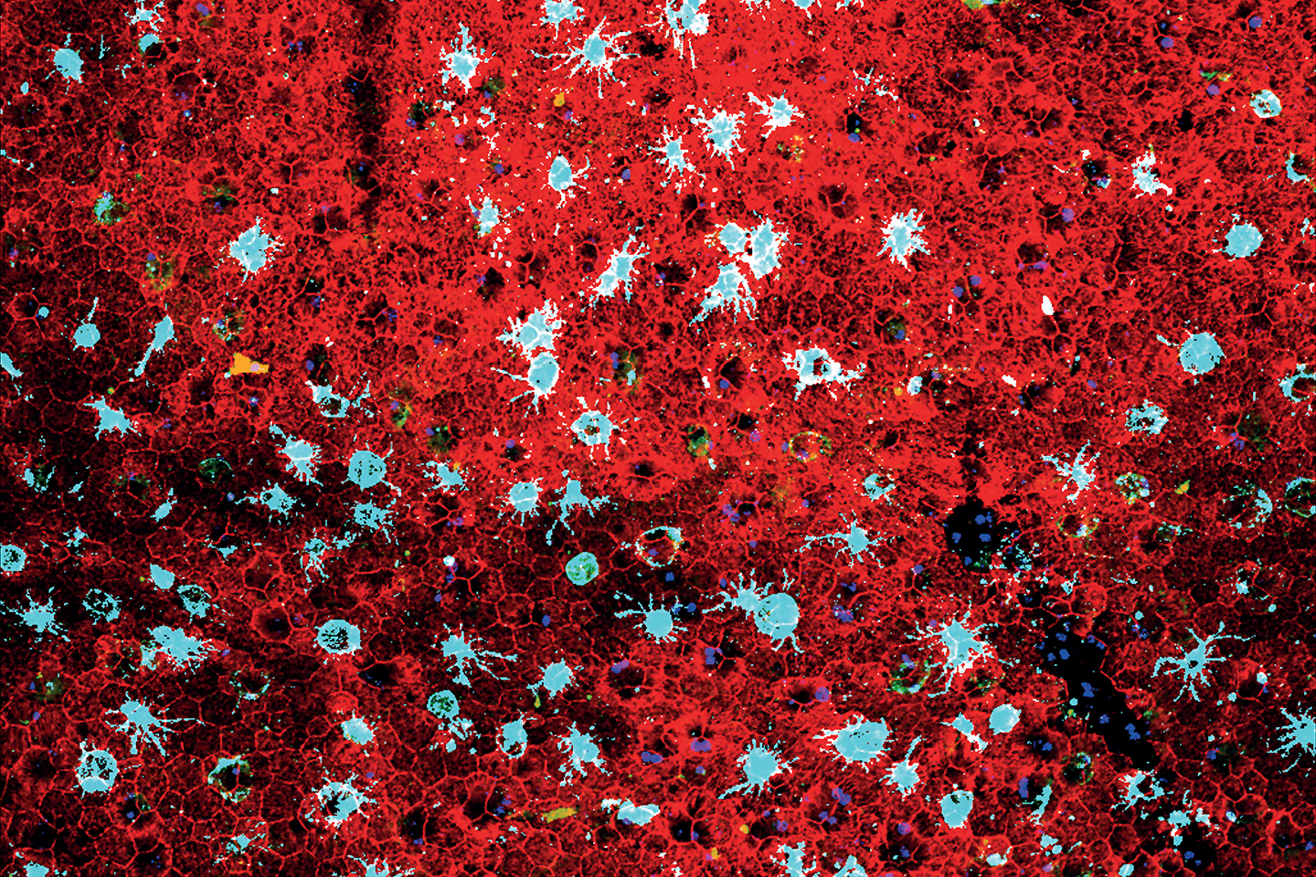 Inflammation is a hallmark of human AMD symptoms. A mouse mutant carrying a mutation in the Tmem135 gene shows massive inflammation and other AMD-like symptoms, making it a good model to study AMD. This image, from Dr. Akihiro Ikeda’s lab, shows the retinal pigment epithelial (RPE) layer of a mouse model of accelerated retinal aging. Red signals represent RPE cells with nucleus (blue), while cyan signals represent activated microglia (immune cells) in the subretinal space. • IMAGE COURTESY OF THE IKEDA LAB.